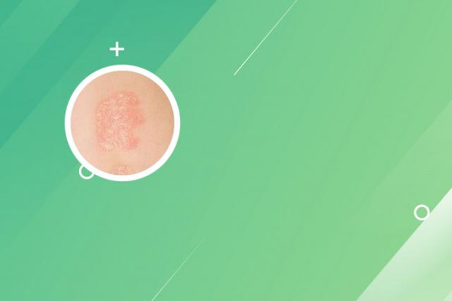 鸡西治疗牛皮癣去哪好