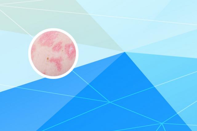 黑龙江银屑病研究中心